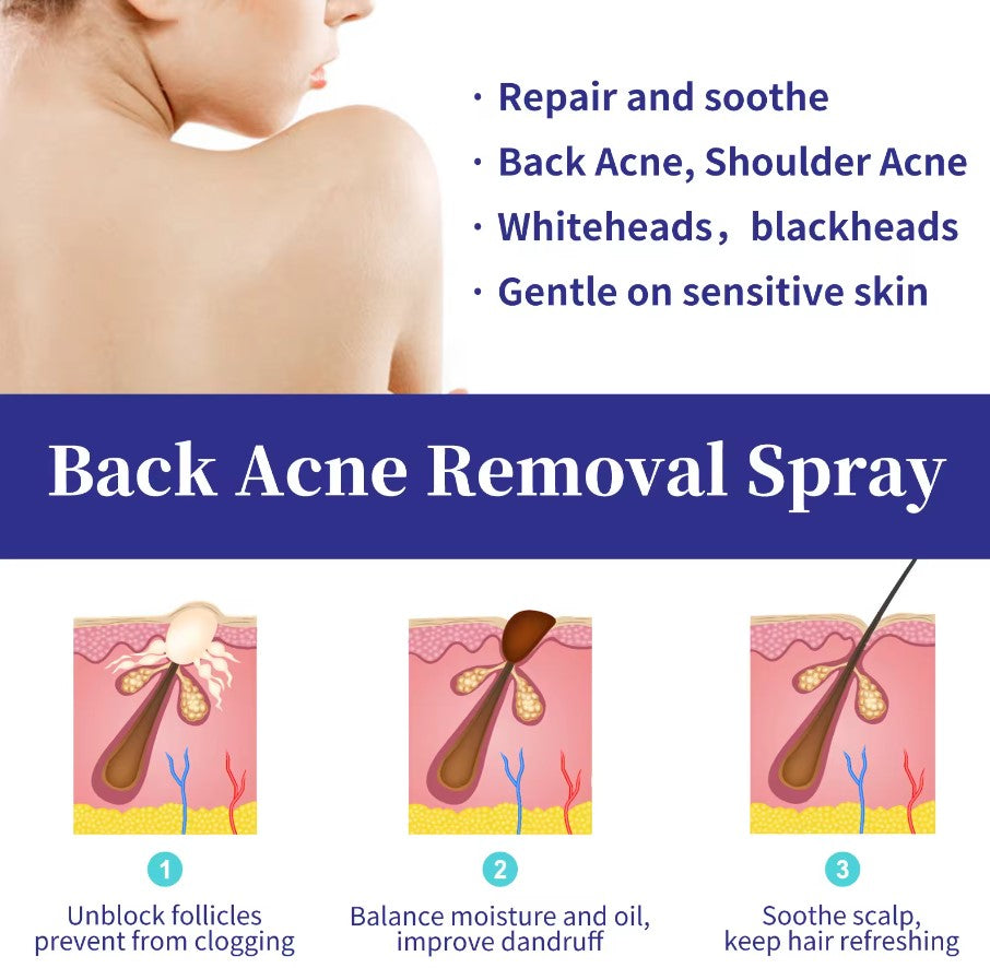 Spray para Remover Acné de la Espalda