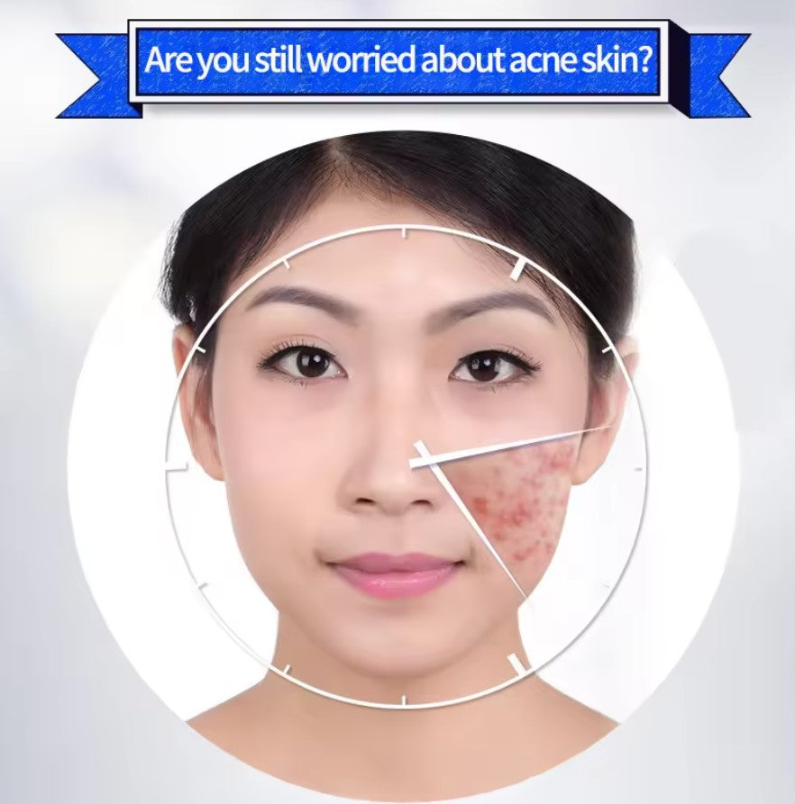 Jabón Facial Removedor de Acné