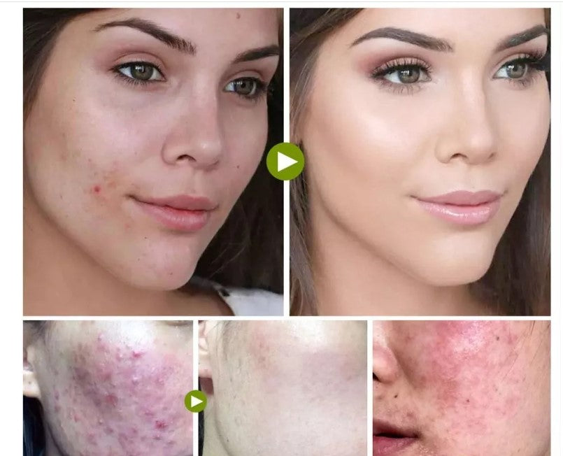 Kit Facial Piel Grasa y/o Acné